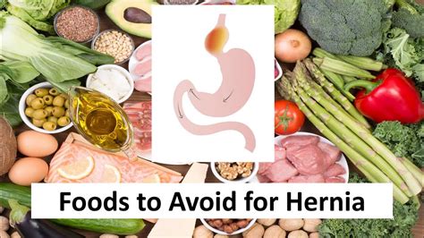 Foods To Eat And Avoid For Hiatal Hernia Smiles - vrogue.co