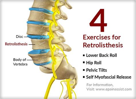 4 Exercises for Retrolisthesis | Ejercicios, Tratamientos, Salud