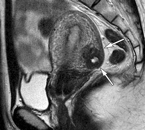 MR Imaging Findings of Adenomyosis: Correlation with Histopathologic Features and Diagnostic ...