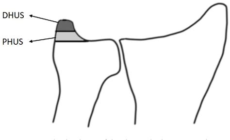 Figure 3 from Displaced sigmoid notch fracture and higher patient age are Displaced sigmoid ...