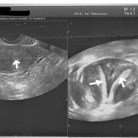 Illustration of uterus didelphys in our clinical case. The arrows are... | Download Scientific ...