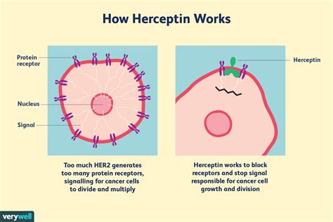 Herceptin Therapy for Breast Cancer