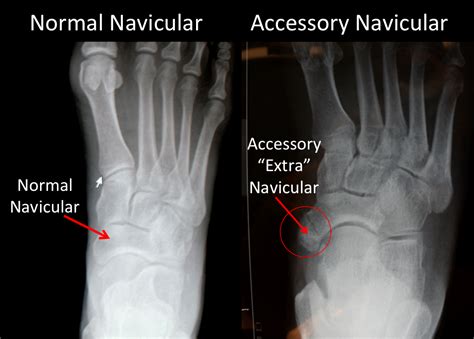 Navicular Anatomy