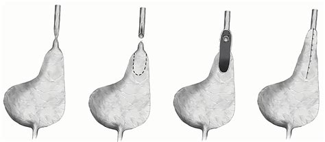 SciELO - Brasil - Re-do Boari flap for recurrent ureteric stricture Re-do Boari flap for ...