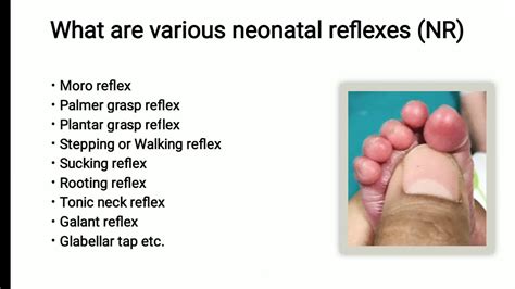 Plantar Grasp Reflex Newborn