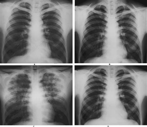 Phosgene and Toxic Gases | Basicmedical Key