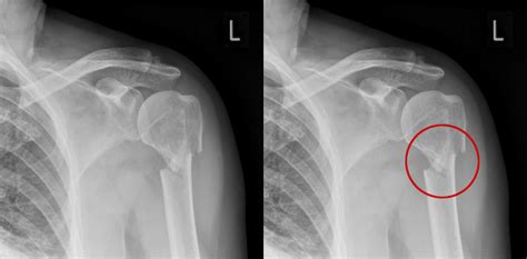 Trauma Humerus X Ray Positioning