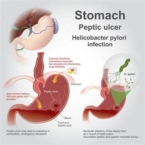 Trust Your Gut When it Comes to Stomach Ulcers | Gastroenterologists ...