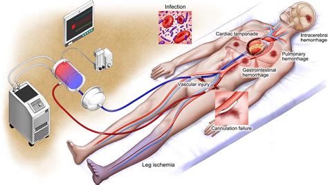 Extracorporeal Cardiopulmonary Resuscitation for Out‐of‐Hospital ...