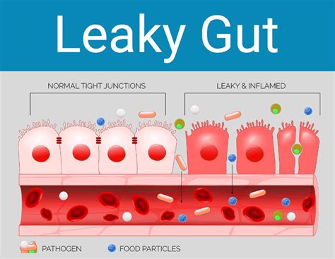 How to Find the Best Leaky Gut Diet for Your Needs