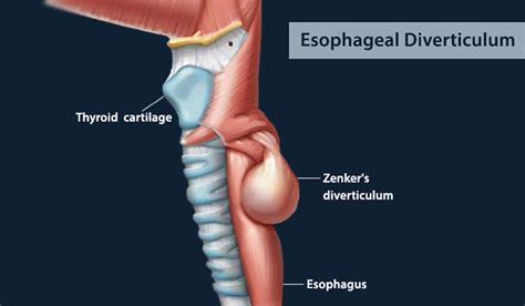 Esophageal diverticulum causes, types, symptoms, diagnosis & treatment