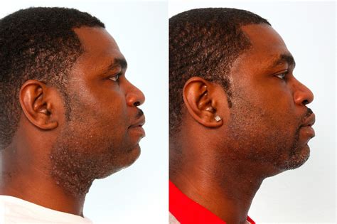 Laser Hair Removal Photos | Houston, Tx | Patient 10171