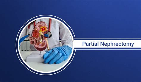 Everything to know about Partial Nephrectomy