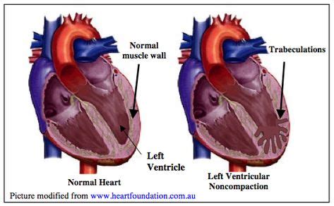 HEY! It's my heart! No joke. There is some serious LVNC going on there. (With images) | Heart ...