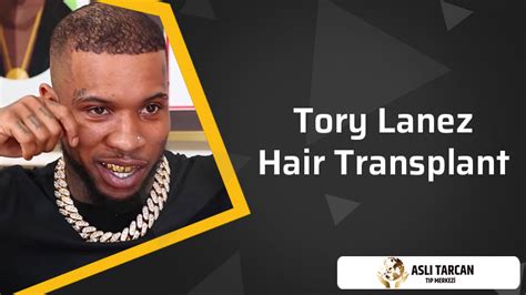 Tory Lanez Hair Transplant | Asli Tarcan Clinic