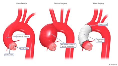 Thoracic Aortic Aneurysm - Newport Cardiac & Thoracic Surgery