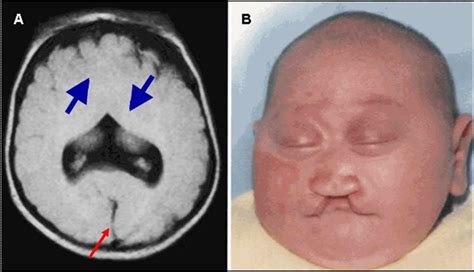 Holoprosencephaly | Treatment, Diagnosis, Sonography