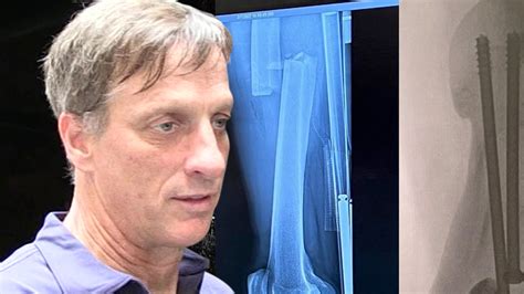 Tony Hawk Suffers Severe Broken Leg In Skating Accident - Archyde