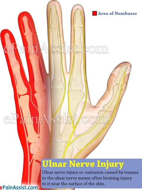 Ulnar Nerve Injury | Ulnar nerve, Ulnar nerve entrapment, Nerve entrapment