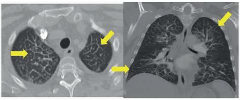 Pulmonary Edema (Interstitial) | Radiology Key