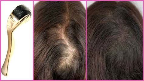 HOW TO REGROW HAIR WITH A DERMA ROLLER│DERMA ROLLING SCALP FOR FASTER ...