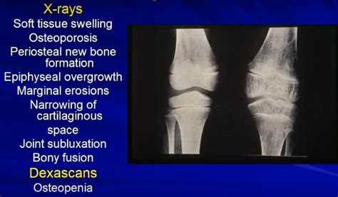 Juvenile Idiopathic Arthritis — OrthopaedicPrinciples.com