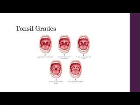 Tonsilitis and quinsy - YouTube