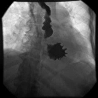 Upper gastrointestinal series showing organoaxial volvulus. | Download Scientific Diagram