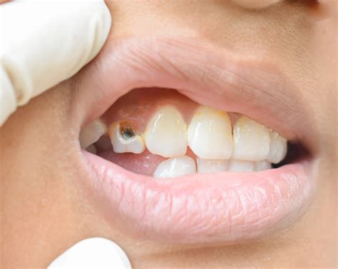 What To Do When Front Tooth Cracked | Springvale Dental Clinic