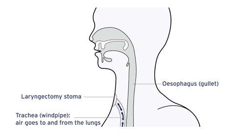 3.07 TOTAL LARYNGECTOMY | Jacob Medical Advisors