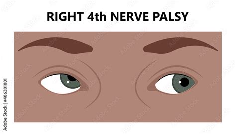 Diplopia double vision test exam brain nerve dry eye palsy gravis ...