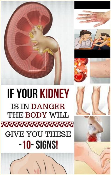 Damaged kidneys; If you have these symptoms you should go to the doctor ...