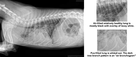 Pneumonia Gestão | Tombouctou