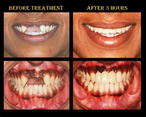 » Front tooth replacement with basal implants