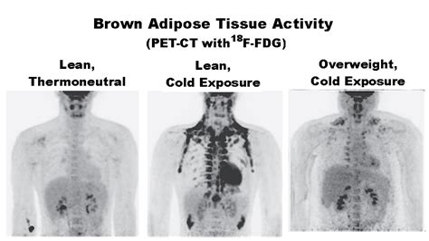 Brown fat could play key role in fighting obesity