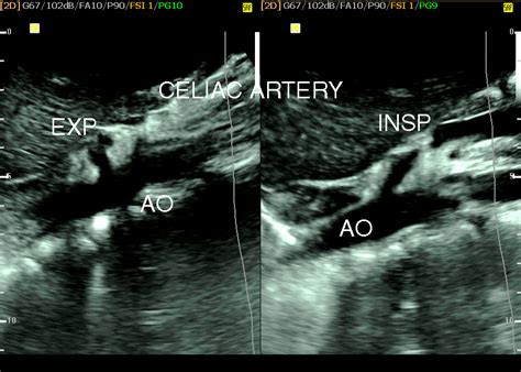 Figure 1A. Normal B mode ultrasound of celiac artery during inspiration and expiration with no ...