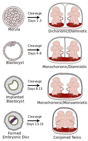 Monochorionic twins - Wikipedia