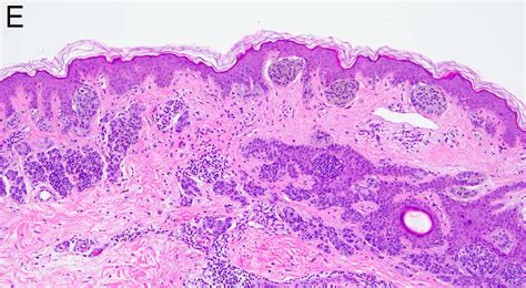 Compound Nevus Histology