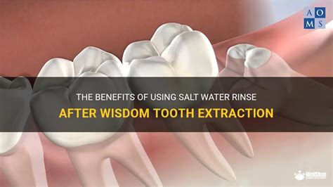 The Benefits Of Using Salt Water Rinse After Wisdom Tooth Extraction | MedShun