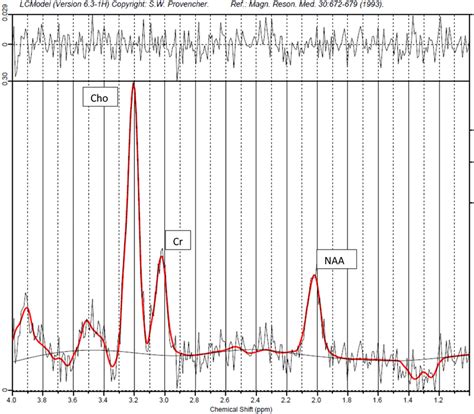 Representative 1 H-MRS LCModel spectral output in a preterm infant ...