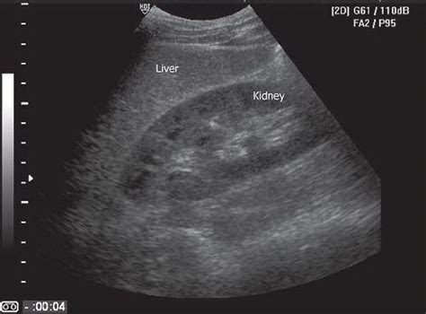 Left Kidney Ultrasound