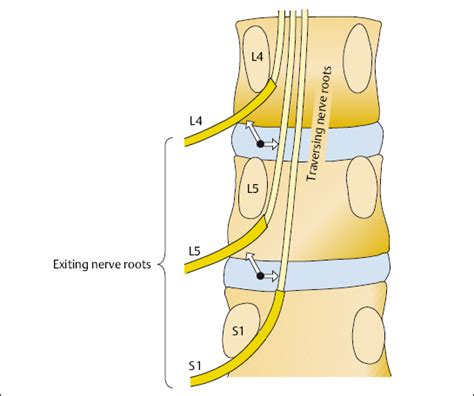 Lumbar Injection Therapy | Anesthesia Key