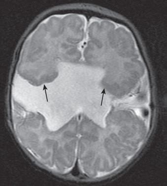 Prosencephalic Development | Neupsy Key