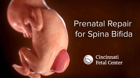 Spina Bifida Medical Animation | Cincinnati Fetal Center - 365 Health Care