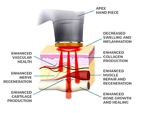 Aspen Apex Laser Therapy | Dr. Chiungos, Chiropractor, Chelmsford MA