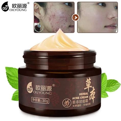 Herbal Acne Cream Anti Pimple Spot Acne Scars Blackhead Removal Cream Whitening Beauty Skin Face ...