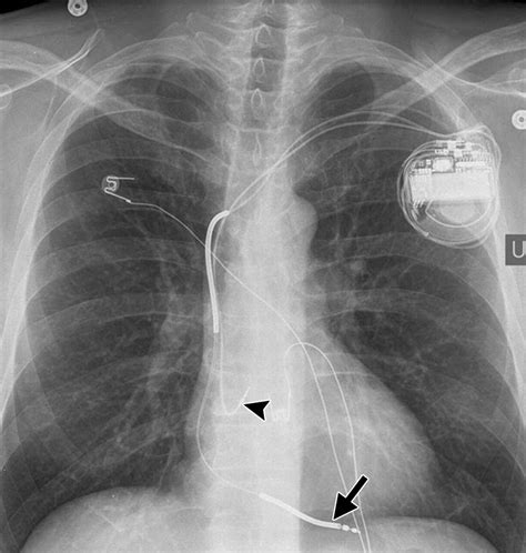 Radiography of Cardiac Conduction Devices: A Comprehensive Review | RadioGraphics