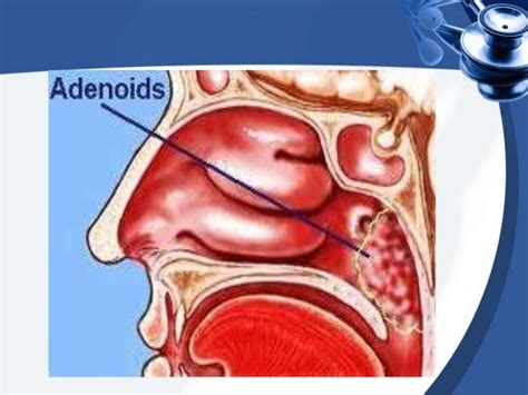 Adenoids