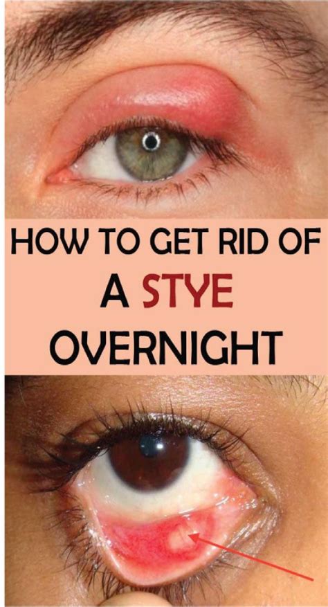 How To Get Rid Of A Stye Overnight | Eye stye remedies, Stye remedy, Health