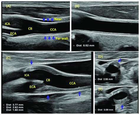 CIMT and carotid plaque assessment. (A) CIMT is a double-line pattern... | Download Scientific ...